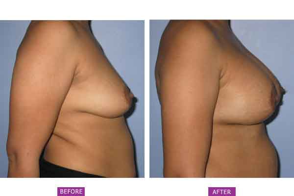 Case 7 : Breast Augmentation : Side View