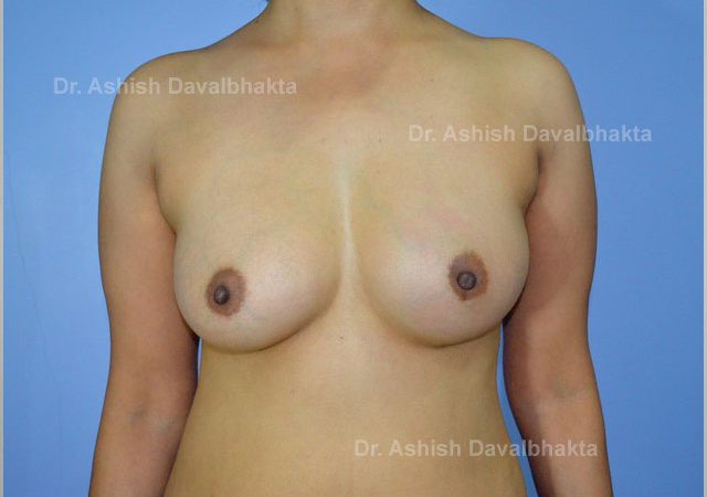 Case 2 : Breast Augmentation with fat grafting: Front View (After)