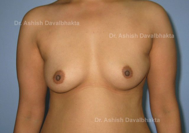 Case 2 : Breast Augmentation with fat grafting: Front View (Before)