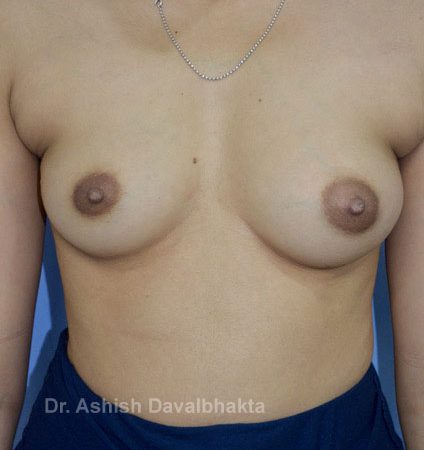 Case 3 : Breast Augmentation with fat grafting: Front View (Before)