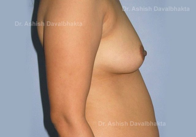 Case 2 : Breast Augmentation with fat grafting: Side View (Before)