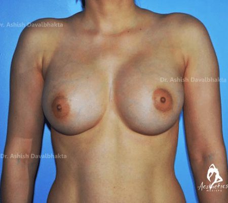 Case 4 : Breast Augmentation : 300cc Dual Plane 1 Augmentation