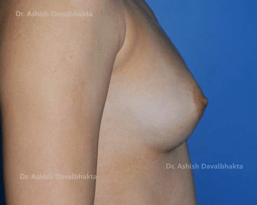 Case 4 : Breast Augmentation : Side View (Before)