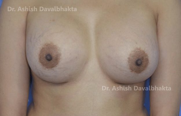 Case 5 : Breast Augmentation Surgery : 355 Silicone Dual Plane 1 Implant : (After)