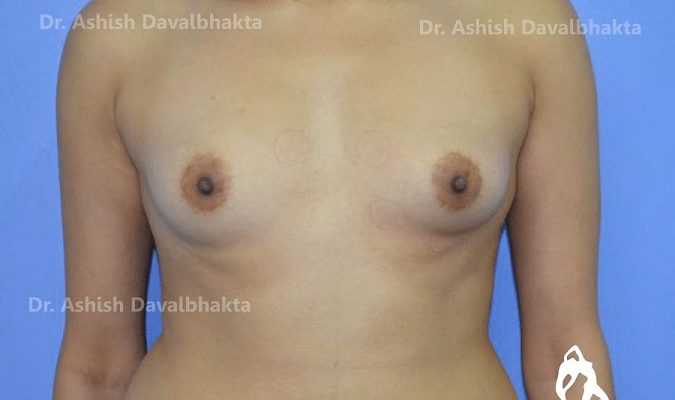 Case 5 : Breast Augmentation Surgery : 355 Silicone Dual Plane 1 Implant : (Before)